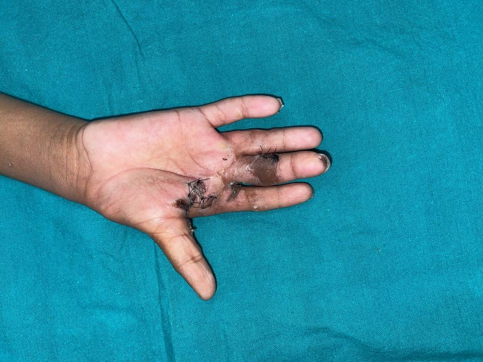 After surgery