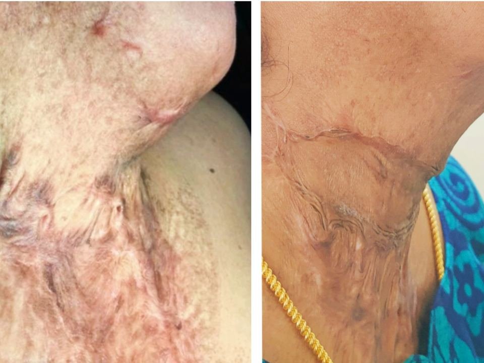After surgery