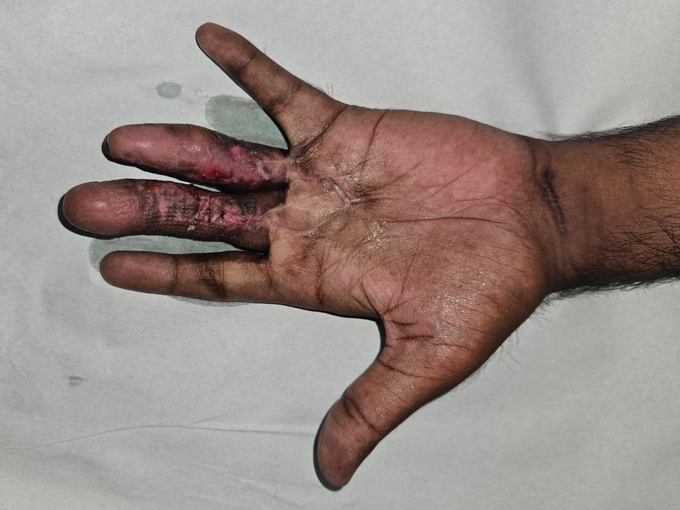 After surgery