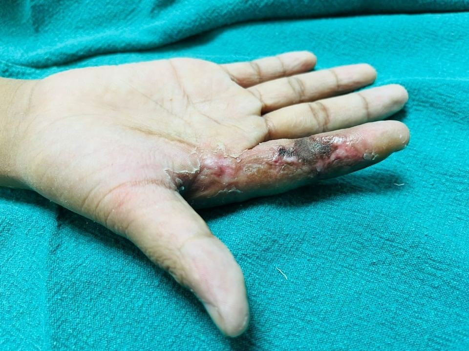 After surgery