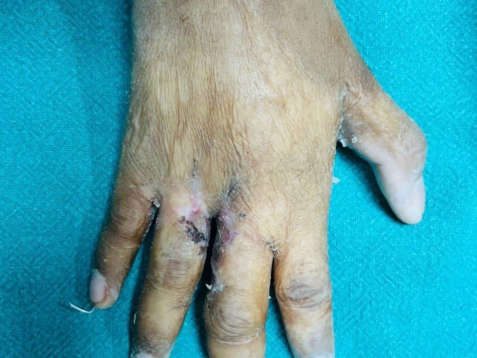 After surgery