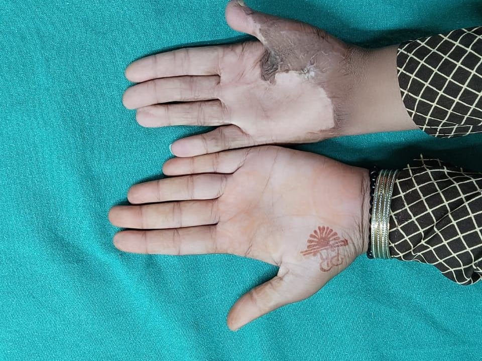 After surgery