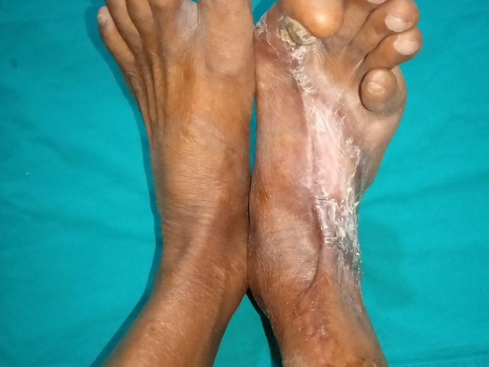 After surgery