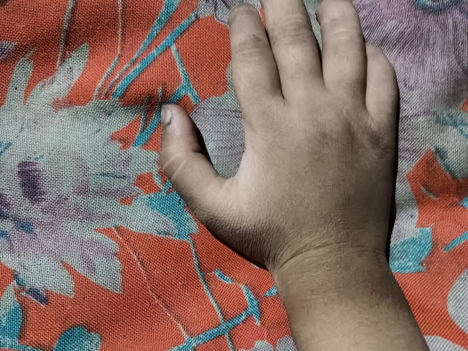 After surgery