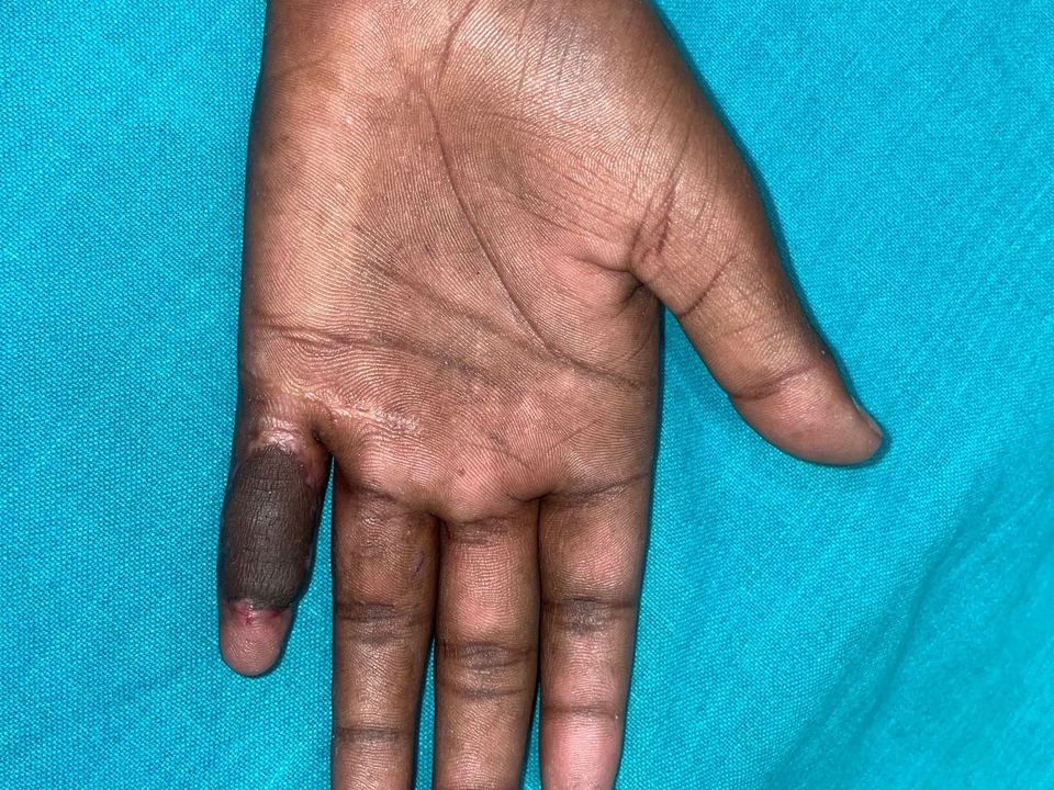 After surgery