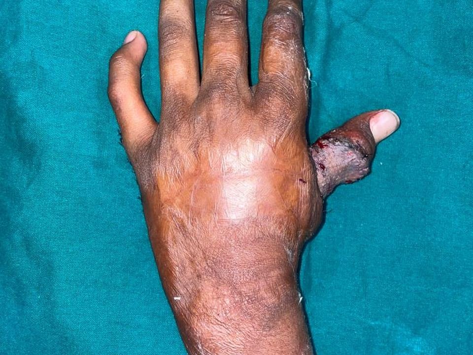 After surgery