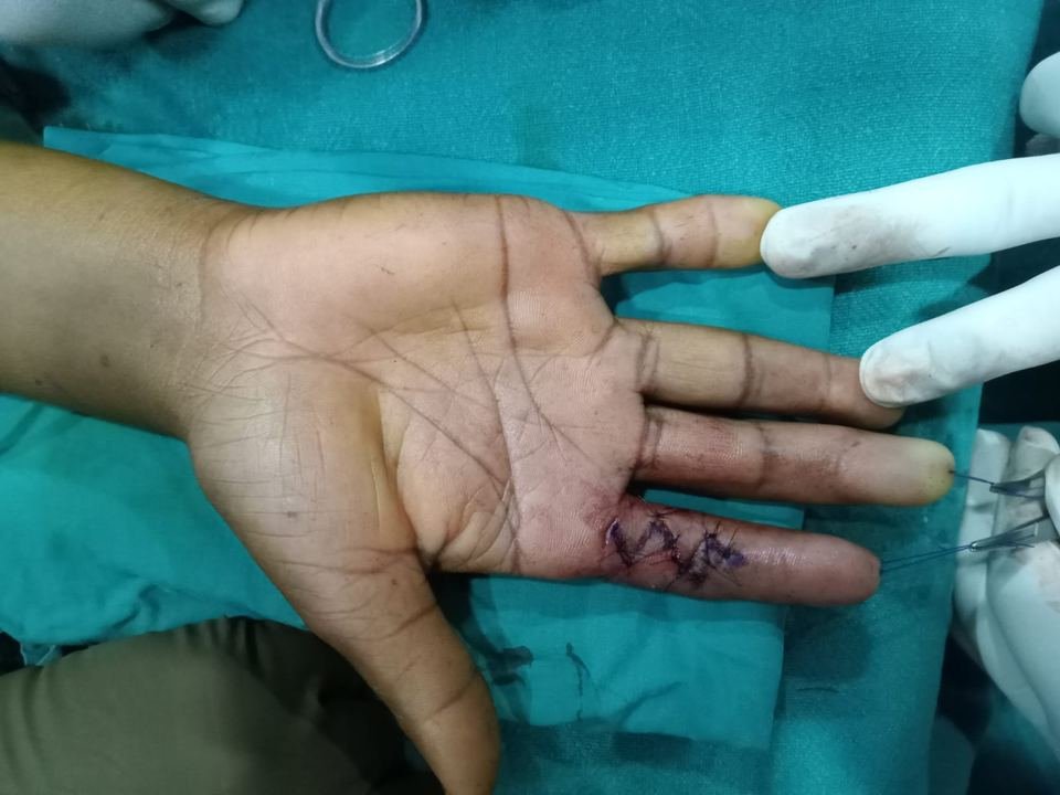 After surgery
