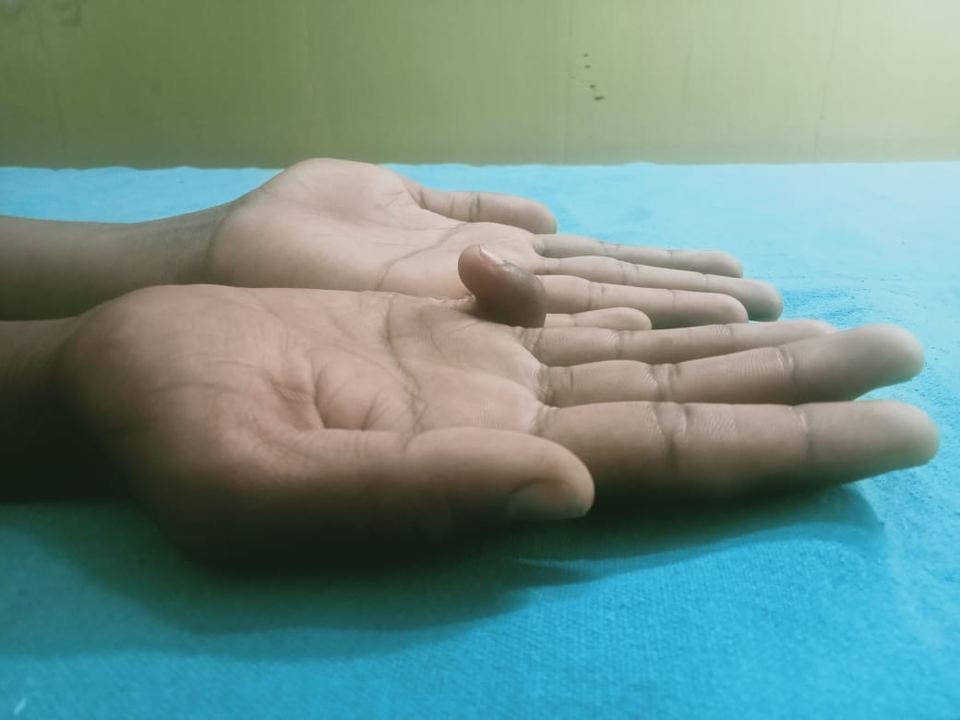 After surgery