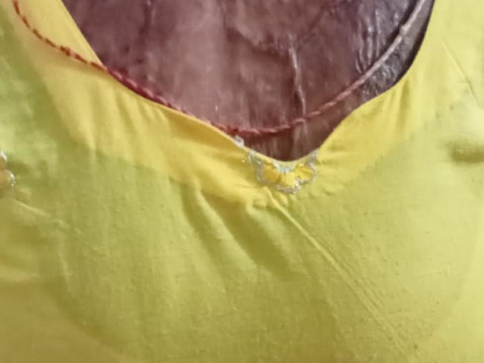 After surgery