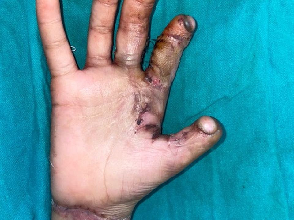 After surgery