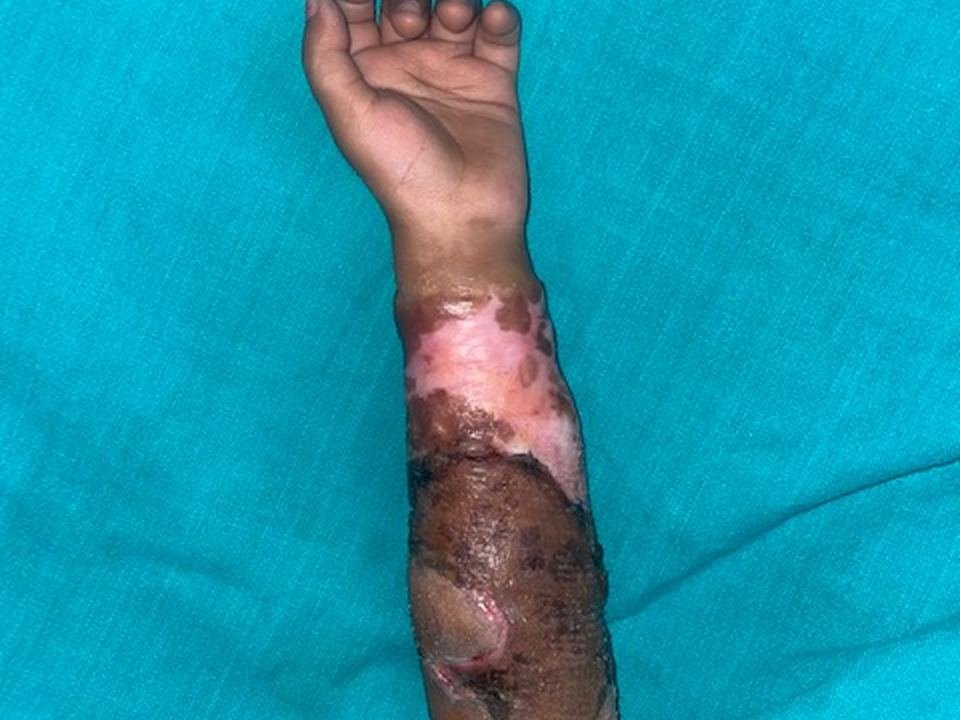 After surgery