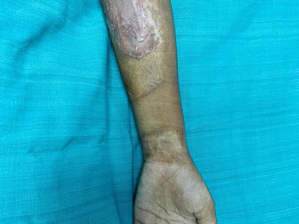 After surgery