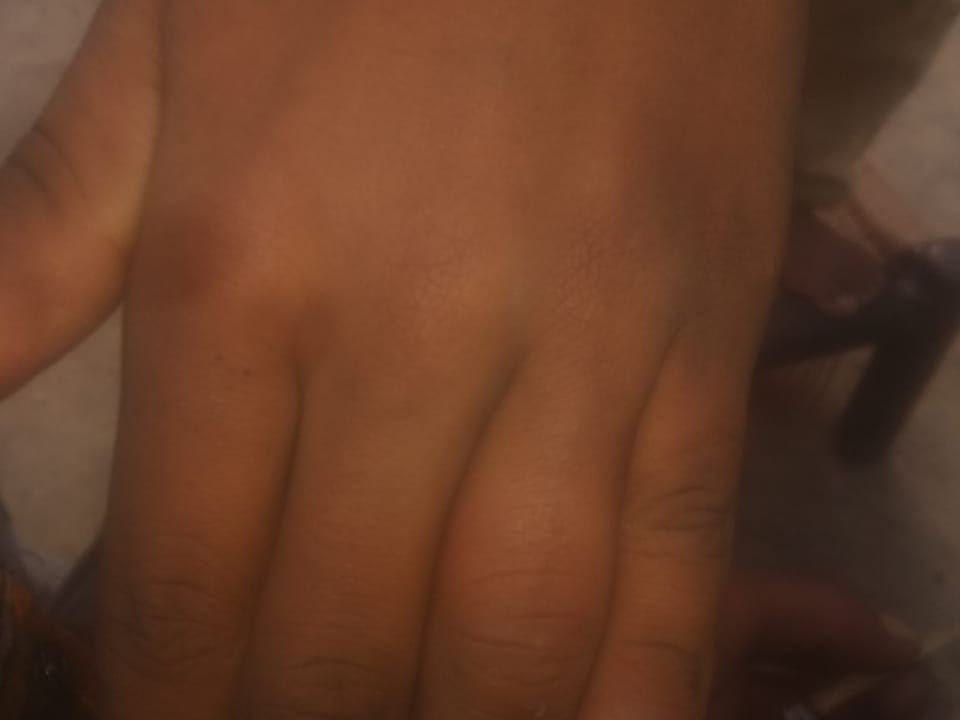 After surgery