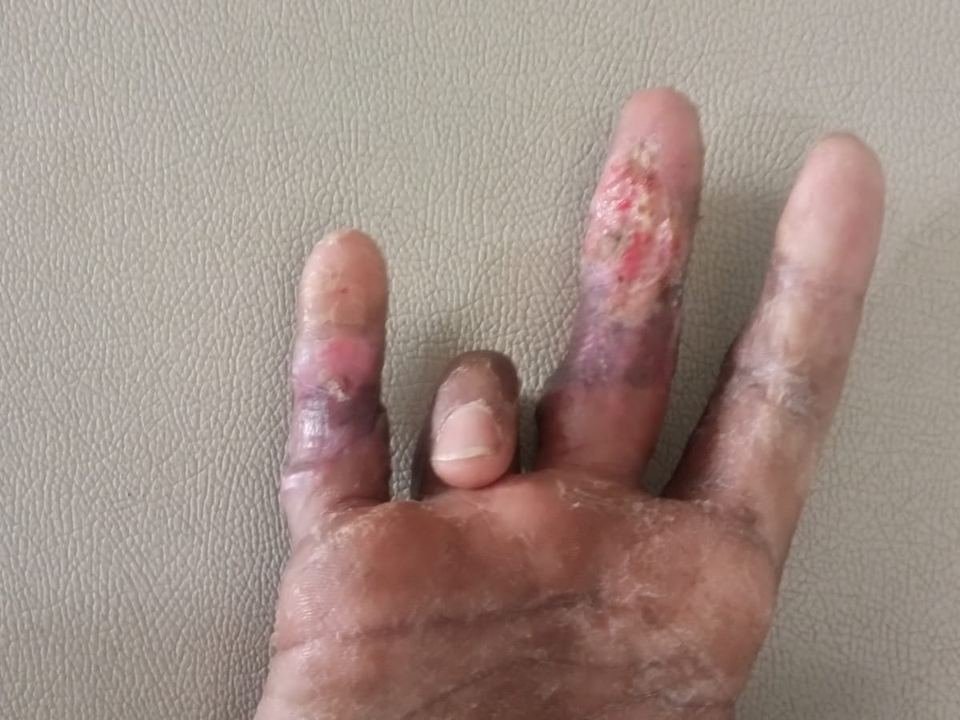 After surgery