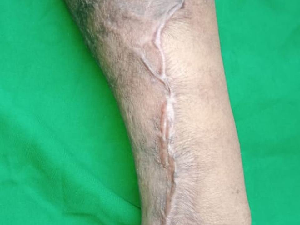 After surgery