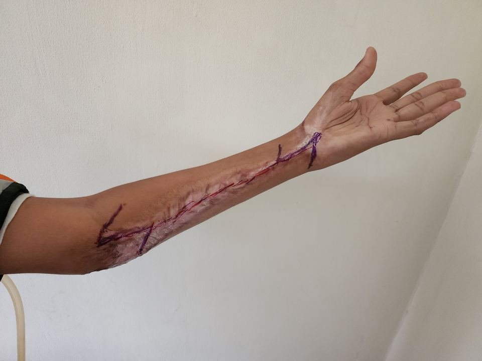 After surgery