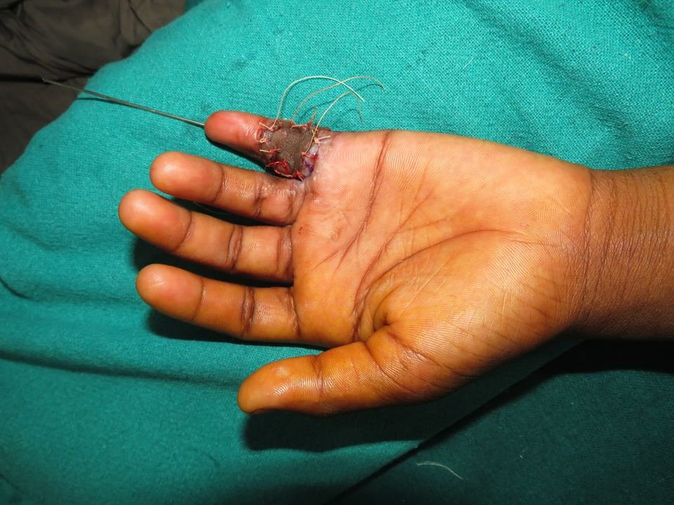 After surgery