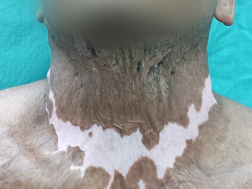 After surgery