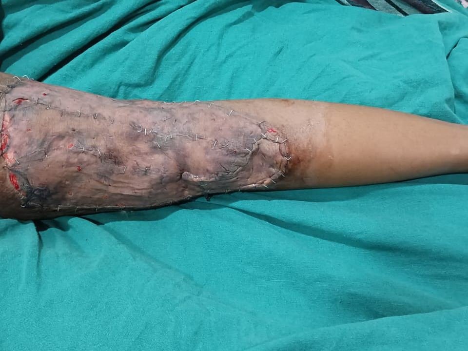 After surgery
