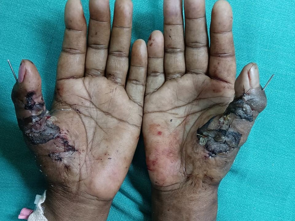 After surgery
