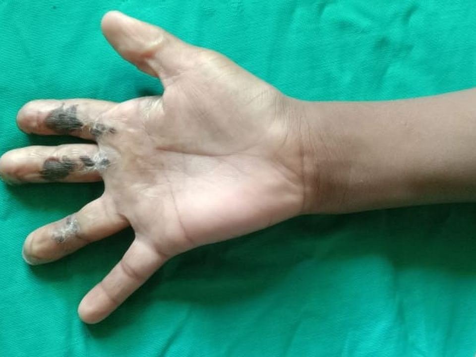 After surgery