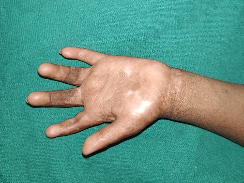 After surgery