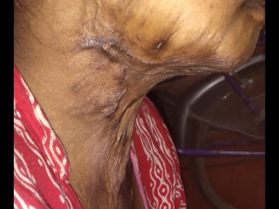 After surgery