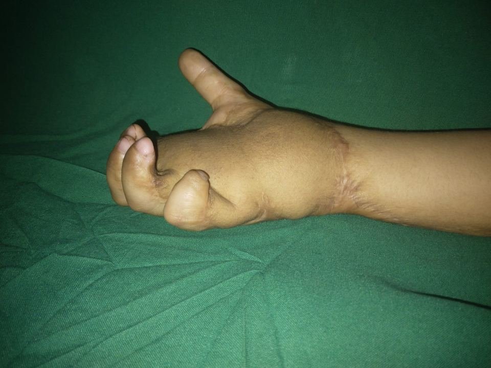 After surgery